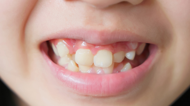 Teeth Crowding